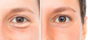 Surgical options: blepharoplasty